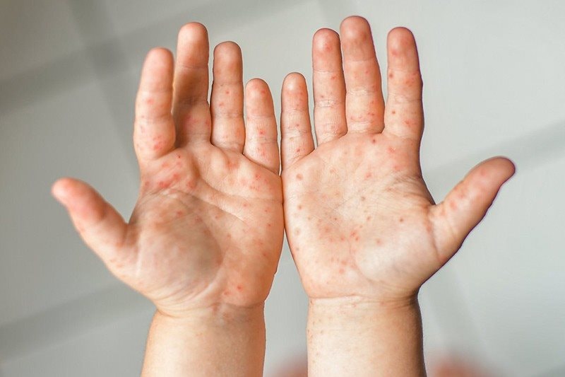 tế - Giáo dụcHà Nội ghi nhận 5 ổ dịch tay chân miệng tại các quận, huyện trong một tuần
